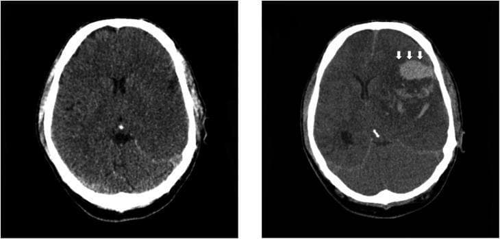 Side-by-side axial non-contrast CT head scans demonstrating the progression of an acute ischemic stroke. The initial scan (left) shows extensive loss of gray-white matter differentiation and sulcal effacement throughout the left cerebral hemisphere, consistent with a large acute middle cerebral artery (MCA) territory infarction. The follow-up scan (right) obtained two days later reveals hemorrhagic transformation within the infarcted region, visualized as a focal area of high-density parenchymal hematoma (indicated by white arrows). Associated mass effect is evident by the effacement of the ipsilateral lateral ventricle and midline shift toward the right. This comparison illustrates a severe complication of large-vessel ischemic stroke, highlighting the transition from cytotoxic edema to secondary intracranial hemorrhage and subsequent increased intracranial pressure.