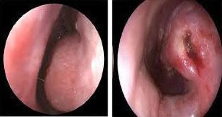 Side-by-side diagnostic nasal endoscopy images comparing a patient's nasal cavity before and after submucous diathermy (SMD) for inferior turbinate hypertrophy. The preoperative image on the left shows a significantly enlarged, edematous inferior turbinate with a smooth, pink mucosal surface, resulting in marked narrowing of the nasal airway. The postoperative image on the right demonstrates a notable reduction in turbinate volume and a wider nasal passage. The treated mucosa exhibits focal changes, including a darker, cauterized area with irregular texture and slight reddish-brown discoloration, consistent with the immediate effects of thermal diathermy used to induce tissue shrinkage through submucosal fibrosis and vessel thrombosis. This comparison illustrates the surgical objective of turbinoplasty: maximizing the nasal airway space while preserving the overlying mucosal integrity.