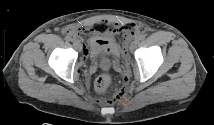 Axial non-contrast computed tomography (CT) scan of the pelvis demonstrating extensive gas collections in multiple compartments. Intraperitoneal gas (pneumoperitoneum) is visible as small, well-defined black bubbles (white arrows) located predominantly along the anterior abdominal wall and between visceral structures. Substantial retroperitoneal gas (orange arrows) is also evident, dissecting along the fascial planes and posterior pelvic structures. Key anatomical landmarks include the iliac wings and the distended pelvic cavity. These findings represent a significant cephalad extension of necrotizing fasciitis (Fournier's gangrene), where gas-producing organisms have tracked from the perineum into the abdominal and retroperitoneal spaces. This diagnostic image is used to illustrate the severity of soft-tissue infections and the importance of cross-sectional imaging in assessing surgical debridement margins.
