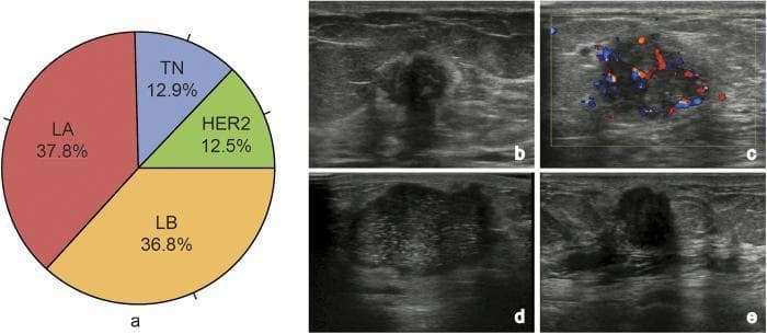 Educational medical graphic comparing breast cancer subtypes via a distribution chart and diagnostic ultrasound imaging. Panel (a) is a pie chart showing the prevalence of molecular subtypes: Luminal A (LA, 37.8%), Luminal B (LB, 36.8%), HER2-enriched (12.5%), and Triple-Negative (TN, 12.9%). Panels (b–e) present diagnostic ultrasound images illustrating characteristic features for each: (b) Luminal A (LA) subtype displaying a distinct hyperechoic halo and significant posterior acoustic shadowing; (c) Luminal B (LB) subtype demonstrated via color Doppler showing internal vascularity; (d) HER2-enriched subtype showing internal punctate calcifications and posterior acoustic enhancement; (e) Triple-Negative (TN) subtype presenting as an oval-shaped mass with a micro-lobulated margin. This comparison highlights how B-mode and Doppler ultrasound features such as margin morphology, echogenic boundary, and posterior acoustic phenomena vary across breast cancer molecular classifications, aiding in radiological-pathological correlation.
