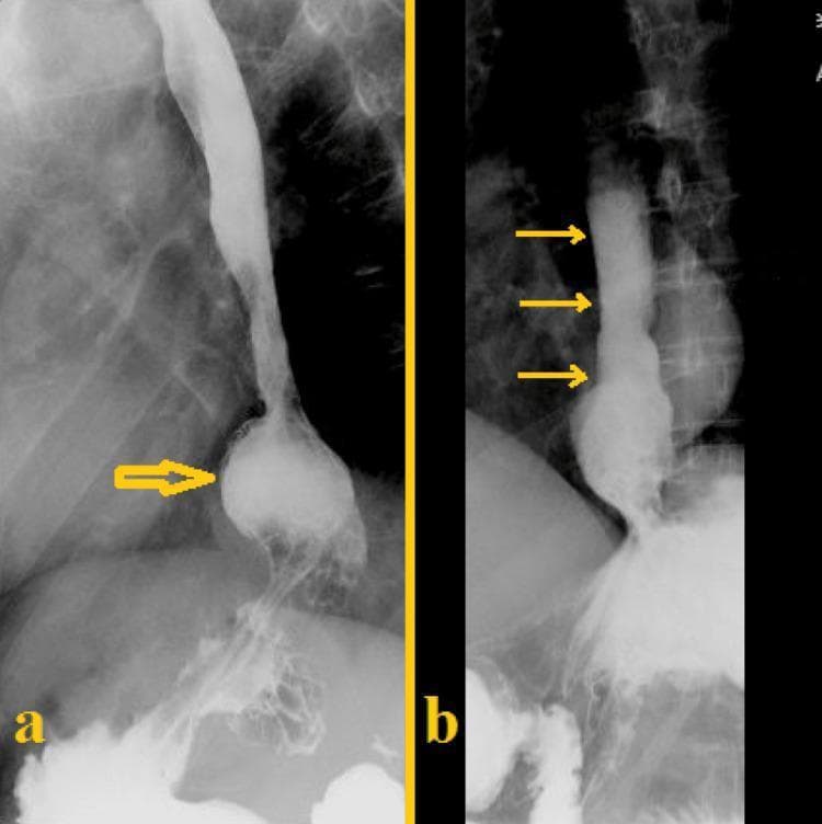 This composite diagnostic image consists of two panels (a and b) showing a barium esophagogram, a radiographic study used to evaluate the upper gastrointestinal tract. Panel (a) illustrates a sliding hiatal hernia, indicated by a yellow arrow pointing to a saccular outpouching of barium-filled gastric tissue protruding through the esophageal hiatus into the thoracic cavity. The gastric mucosal folds are visible above the level of the diaphragm. Panel (b) demonstrates gastroesophageal reflux disease (GERD), with three yellow arrows highlighting the retrograde flow of the radio-opaque barium contrast material from the stomach upwards into the distal and mid-esophagus. These images provide key clinical evidence for structural abnormalities (hiatal hernia) and functional impairments (reflux) of the gastroesophageal junction. The study is typical of those used in gastroenterology and radiology to diagnose causes of dysphagia, chronic heartburn, or regurgitation.