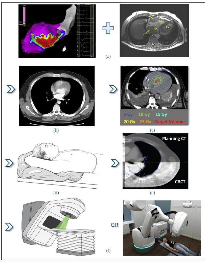 This infographic illustrates the complete workflow for Stereotactic Arrhythmia Radioablation (STAR), a non-invasive treatment for cardiac arrhythmias like ventricular tachycardia. The process is depicted in six stages: (a) target definition through the fusion of electro-anatomical mapping with cardiac imaging; (b) acquisition of a planning computed tomography (CT) scan for anatomical reference; (c) radiotherapy dosimetry planning, showing a cross-sectional thoracic CT with isodose lines ranging from 5 Gy to 25 Gy surrounding the red-highlighted cardiac target volume; (d) patient positioning and immobilization using a vacuum-assisted mold to ensure reproducible setup; (e) image-guided alignment using a comparison between the planning CT and cone-beam CT (CBCT) to verify target accuracy; and (f) radiotherapy delivery options, displaying a conventional linear accelerator (Linac) and a robotic CyberKnife system. The diagram emphasizes the multidisciplinary integration of electrophysiology and radiation oncology for precise, high-dose focal radiation delivery to arrhythmic cardiac substrates.