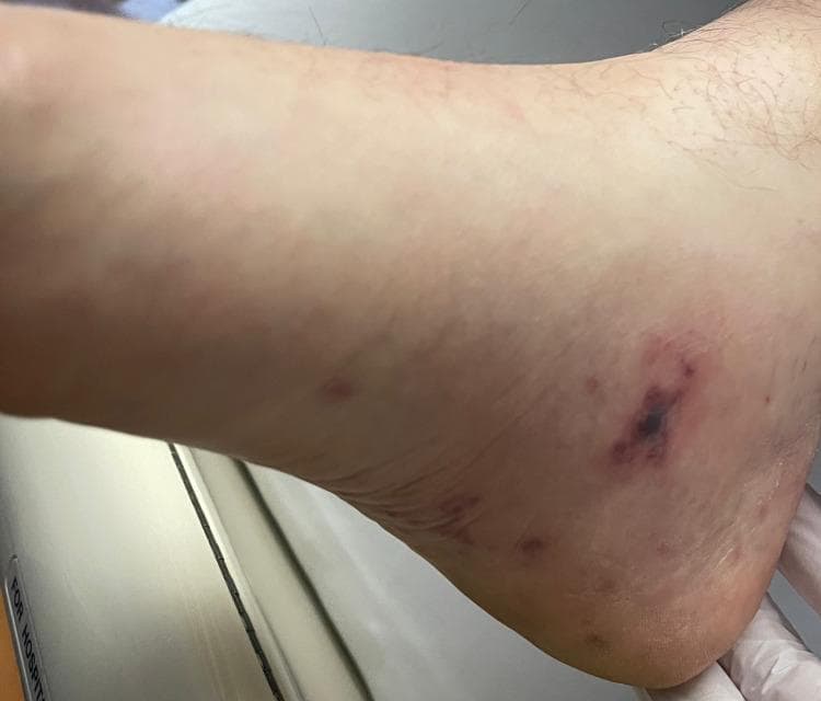 Clinical photograph of the medial aspect of the right foot and ankle demonstrating immunologic and vascular cutaneous manifestations of infective endocarditis. The primary finding is a well-circumscribed, tender, erythematous to violaceous (red-purple) nodular lesion located inferior to the medial malleolus, consistent with an Osler node. The lesion exhibits a central dark purpuric area surrounded by a diffuse inflammatory halo. Additionally, several smaller, discrete, non-blanching erythematous macules are visible in the surrounding area, which may represent Janeway lesions. The image serves as an educational reference for identifying peripheral stigmata of bacteremia, specifically related to Staphylococcus aureus endocarditis. Key concepts illustrated include the distinction between painful, immune-mediated Osler nodes and painless, embolic Janeway lesions in the context of Duke criteria for diagnosing valvular vegetations.