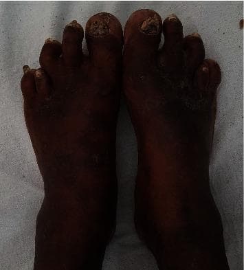 Clinical photograph showing a dorsal view of bilateral human feet demonstrating brachymetatarasia. The most prominent finding is the symmetric shortening of the fourth metatarsals, resulting in the fourth toes appearing proximally displaced relative to the standard metatarsal arch. Additional skeletal and integumentary features include dystrophic and thickened toenails (onychodytrophy) and areas of hyperpigmentation and skin thickening consistent with healed psoriatic plaques. These findings are clinically significant as phenotypic markers often associated with Albright hereditary osteodystrophy (AHO), pseudohypoparathyroidism, or pseudopseudohypoparathyroidism. The image serves as a diagnostic educational resource for identifying specific digital malformations and their associated cutaneous manifestations in the context of metabolic or genetic bone disorders.