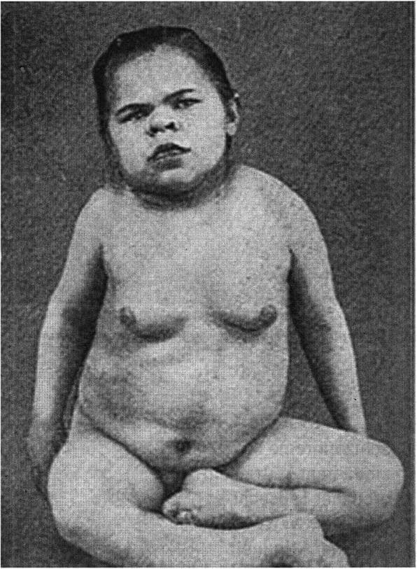 This historical black-and-white clinical photograph depicts a pediatric patient presenting with the classic physical manifestations of severe myxedema due to untreated congenital hypothyroidism. The facial features are characteristic of the condition, including periorbital puffiness (edema), narrowed palpebral fissures, a depressed nasal bridge, and a broad, flattened nose. The lips appear thickened and the tongue may be slightly protruded, typical of macroglossia. The overall body habitus is stocky with a disproportionately short neck and a protuberant abdomen. Significant generalized subcutaneous swelling (myxedema) is evident across the trunk and proximal extremities, giving the skin a thickened, doughy appearance. The patient's posture and seated, cross-legged position reflect the developmental delays and musculoskeletal characteristics associated with prolonged severe thyroid hormone deficiency. This image serves as an educational reference for the systemic and dermatologic signs of primary congenital hypothyroidism and the phenotypic presentation of 'cretinism' as described in historical medical literature.