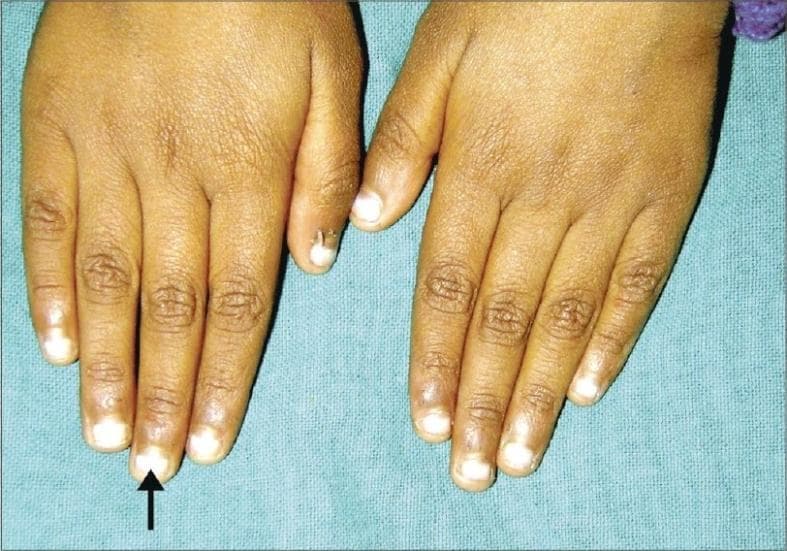 Clinical photograph of the dorsal aspect of both hands in a pediatric patient, demonstrating Mees' lines (true leukonychia). The image shows multiple fingernails with well-defined, single, white transverse bands approximately 2 mm in width. These hypopigmented bands span the entire breadth of the nail plate and run parallel to the lunula. The overlying nail surface is smooth and intact, indicating the pathology is within the nail plate substance rather than a surface deformity. This clinical sign is classically associated with systemic insults such as arsenic poisoning, heavy metal toxicity, or, as in this context, certain chemotherapy regimens for acute lymphoblastic leukemia. The distribution across multiple digits suggests a systemic etiology affecting the nail matrix during a specific period of growth. The presence of these non-blanchable lines is an important diagnostic indicator in dermatology and oncology for tracking toxic exposures or treatment side effects.