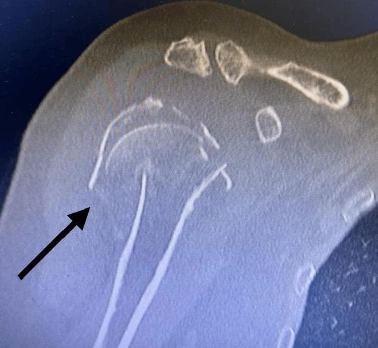 This diagnostic image is a Computed Tomography (CT) scan of the right shoulder, showing a severe proximal humerus fracture. The visual demonstrates a Neer four-part fracture pattern, characterized by the distinct separation and displacement of four major anatomical segments: the humeral head, the greater tuberosity, the lesser tuberosity, and the humeral shaft. An arrow points to the primary fracture site where significant cortical discontinuity is evident. There is a clear loss of normal anatomical alignment, with the humeral head appearing angulated and displaced relative to the glenoid fossa and the humeral shaft. The comminuted nature of the injury is visible through multiple bone fragments in the subacromial and glenohumeral regions. This image is used in medical education to illustrate complex orthopedic trauma, the Neer classification system for proximal humerus fractures, and the surgical considerations for management such as ORIF versus arthroplasty.
