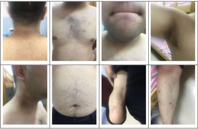 This composite of clinical photographs illustrates physical manifestations of severe insulin resistance in a 22-year-old male. The images display classic dermatological signs across several anatomical regions. Prominent findings include acanthosis nigricans, characterized by hyperpigmented, velvety, and thickened (hyperplastic) plaques localized on the posterior and lateral neck, the axilla (underarm), and the inguinal folds. Additionally, the photographs show significant hypertrichosis, with coarse, dense terminal hair growth across the chest and abdomen. Other visible clinical features include general obesity and darkened skin textures in flexural areas. These cutaneous markers are highly suggestive of systemic metabolic dysfunction, such as Type A Insulin Resistance Syndrome (TAIRS). The visual data serves as an educational tool for identifying skin-based complications of hyperinsulinemia and hormonal imbalances often encountered in endocrinology and dermatology.