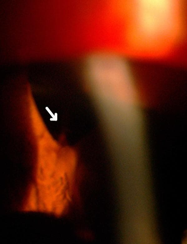 This clinical photograph captures a slit-lamp biomicroscopy examination of the anterior segment of the left eye, focusing on an acute hyphema. The image demonstrates active bleeding into the anterior chamber, characterized by a visible stream of blood (indicated by a white arrow) emanating from a superior peripheral iridectomy site. A vertical slit-lamp beam provides cross-sectional illumination, highlighting the depth of the anterior chamber and the distribution of the blood. The pathology is a direct complication following previous intraocular surgeries, including cataract extraction and trabeculectomy. The image serves as an educational example of post-surgical complications in ophthalmology, specifically demonstrating the localization of a bleeding source in the iris-corneal angle region using slit-lamp illumination. Key concepts illustrated include the management of recurrent hyphema and the anatomical relationship between surgical iridectomy and intraocular hemorrhage.