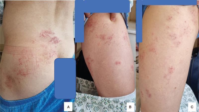 This composite of three clinical photographs (A–C) demonstrates the classic dermatomal distribution of Herpes Zoster (shingles) in an adult patient. Image A shows a posterior view of the lower back and flank, where a cluster of erythematous, vesicular lesions is visible. The rash follows a clear unilateral, oblique path across the skin surface, typical of a lumbar spinal nerve dermatome (specifically L2-L3). Images B and C provide close-up views of the same patient’s thigh, showing additional scattered clusters of small, fluid-filled vesicles on an erythematous base. The lesions exhibit characteristic morphology: grouped papulovesicles that appear in various stages of evolution. The clinical presentation is highly suggestive of varicella-zoster virus reactivation, correlating with the patient's reported radicular pain and motor weakness. The distribution is strictly unilateral, respecting the midline, which is a hallmark diagnostic feature of this condition.