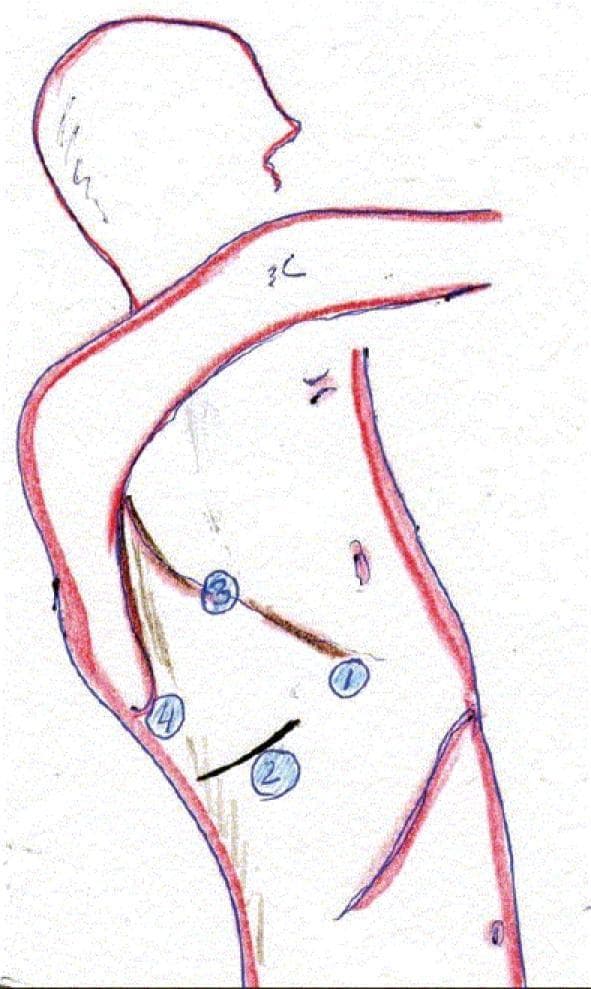 A medical illustration depicting the surgical setup for a right thoracoscopic approach in an Ivor Lewis esophagectomy. The diagram shows a patient in the left lateral decubitus position with the right arm extended forward. Four surgical trocar port sites are numerically labeled (1-4) on the lateral thoracic wall. Port 1 is positioned anteriorly near the midaxillary line. Port 2 is located inferiorly to port 1. Port 3 is placed superiorly and posteriorly, near the posterior axillary line. Port 4 is situated posteriorly and inferiorly, in proximity to the scapula tip. A brown line connects ports 3 and 1, likely indicating the surgical trajectory or line of esophageal mobilization. This diagram serves as a clinical guide for port placement during minimally invasive esophagectomy, emphasizing the relationship between thoracic landmarks and instrument access points for mediastinal lymphadenectomy and esophageal resection.