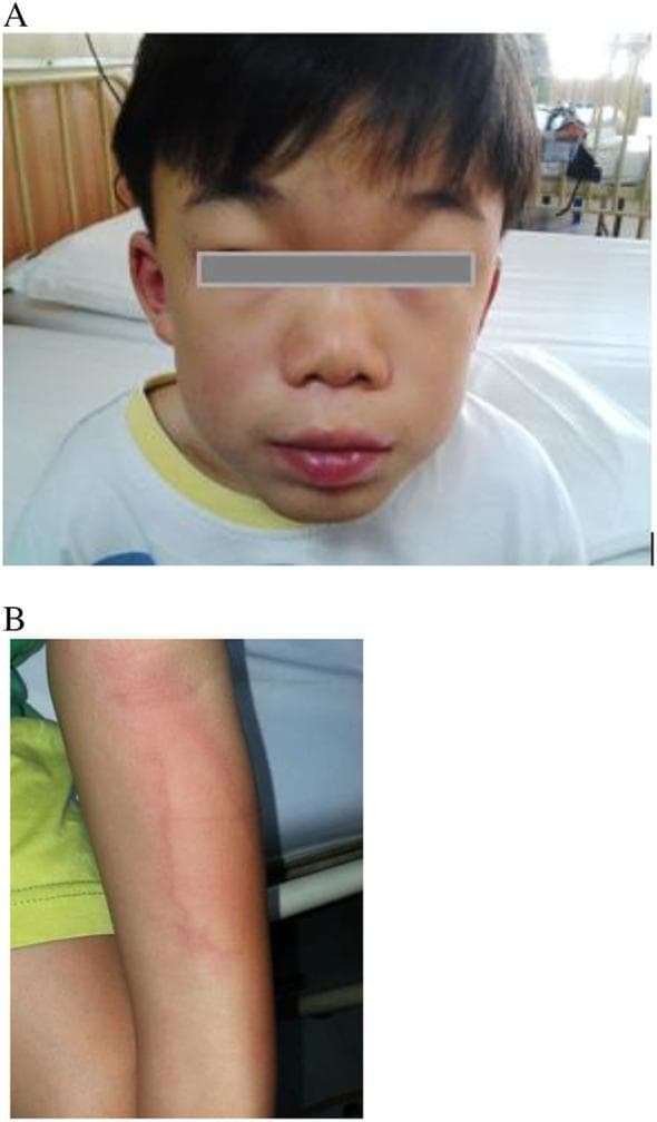 A pair of clinical photographs documenting an infusion-associated reaction in a pediatric patient receiving Enzyme Replacement Therapy (ERT) for Mucopolysaccharidosis (MPS). Panel A is a frontal facial photograph showing marked periorbital edema and swollen lips, accompanied by a diffuse, faint erythematous rash across the cheeks and midface, consistent with angioedema. Panel B focuses on the left forearm, exhibiting a localized urticarial rash characterized by erythematous, blanching wheals with irregular borders. These images illustrate common cutaneous manifestations of a systemic hypersensitivity reaction during intravenous medication administration. The images are highly relevant for medical education concerning the recognition of adverse drug reactions, dermatologic signs of anaphylactoid responses, and the clinical management of metabolic disorders.