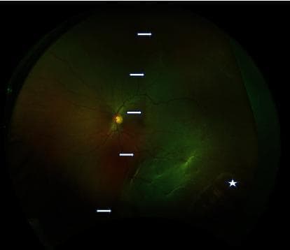 A wide-field fundus photograph of the left eye demonstrating a rhegmatogenous retinal detachment and peripheral retinal pathology. The image reveals a significant temporal hemiretinal detachment, indicated by a series of white arrows marking the demarcation line. The detached portion of the retina exhibits a characteristic lighter, translucent, and slightly opalescent appearance compared to the reddish-orange hue of the attached nasal retina. Faint retinal folds are visible within the detached area, which extends to involve the temporal aspect of the macula, correlating with significant visual acuity loss. In the far peripheral retina, a white asterisk identifies an area of lattice degeneration accompanied by a retinal hole, serving as the likely causative break for the detachment. The optic disc appears well-defined with normal vascular emergence, though the temporal vessels are displaced by the elevated retinal tissue. This image is a classic clinical representation of retinal detachment secondary to peripheral degenerative changes, suitable for teaching diagnostic fundus examination and vitreoretinal pathology.