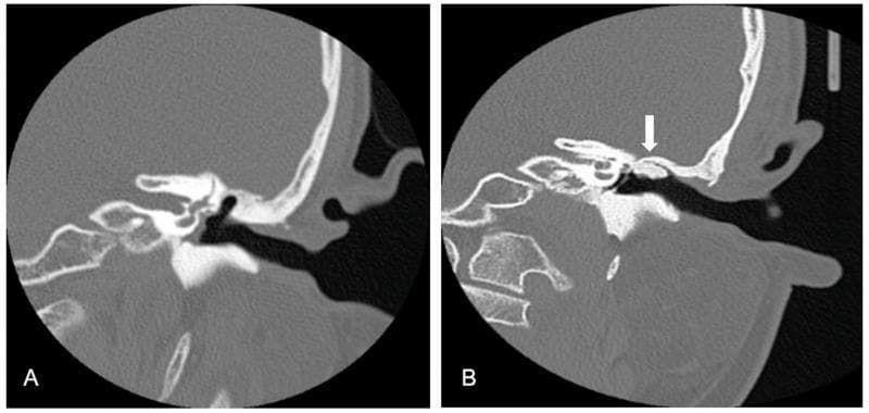 This diagnostic image displays side-by-side high-resolution computed tomography (CT) scans of the temporal bone in the coronal plane, illustrating preoperative and postoperative states of the middle ear. Image (A) shows a preoperative view of a patient with acquired middle ear cholesteatoma. Key findings include clear scutum erosion and a retraction pocket extending into the epitympanum, characterized by the loss of the sharp bony spur of the lateral attic wall and soft tissue opacification. Image (B) demonstrates the same anatomical region four years after functional tympanomastoidectomy. A white arrow indicates the successful reconstruction of the external auditory canal (EAC) using autologous bone grafts. These grafts appear stable and integrated, maintaining the structural integrity of the canal wall. The postoperative scan also highlights restored middle ear function through significant aeration of the middle ear cavity and mastoid air cells. This comparison is used to teach surgical outcomes in otolaryngology, specifically the effectiveness of bone grafting in canal wall reconstruction to prevent recurrent retraction pockets.