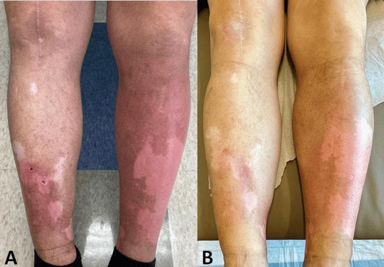 Clinical photograph comparison (A and B) of the lower extremities in a 60-year-old male, demonstrating pemetrexed-induced pseudocellulitis (PIP) and concurrent vitiligo. Image A shows bilateral, asymmetric, poorly demarcated erythematous patches and edema, most pronounced on the left shin. Superimposed are well-demarcated depigmented macules and patches consistent with vitiligo. Image B illustrates the clinical response following an eight-day prednisone taper, showing a significant reduction in diffuse erythema and localized swelling, while the underlying depigmented vitiligo patches remain stable. The photograph serves as a visual reference for differentiating drug-induced pseudocellulitis from bacterial cellulitis, characterized here by the lack of exquisite tenderness, bilateral involvement, and temporal association with pemetrexed infusion. The case highlights diagnostic features for oncologists and dermatologists managing chemotherapy-related cutaneous adverse drug reactions.