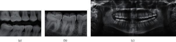 This comparative medical illustration presents three primary types of diagnostic dental radiography. (a) Bitewing X-ray: A localized intraoral view capturing the coronal portions and cervical thirds of the roots of both maxillary and mandibular teeth in a specific segment. It is primarily used to detect interproximal caries and monitor alveolar bone levels. (b) Periapical X-ray: An intraoral radiographic view focusing on a small group of teeth, showing the entire tooth structure from the crown to the apex of the root, as well as the surrounding periapical bone and periodontal ligament space. This modality is essential for assessing root morphology and apical pathology. (c) Orthopantomogram (OPG): An extraoral panoramic radiograph providing a comprehensive, curved-plane view of the entire maxillofacial region. It displays all teeth in both the maxillary and mandibular arches, the temporomandibular joints (TMJ), and the maxillary sinuses, serving as a vital tool for orthodontic planning and forensic odontology.