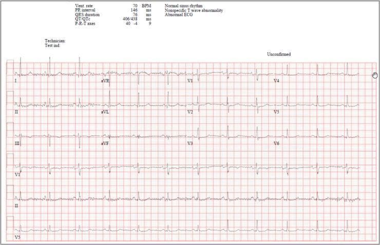 A standard 12-lead electrocardiogram (ECG) recorded on a red grid background, demonstrating clinical baseline data for a patient case. The recording includes standard limb leads (I, II, III), augmented leads (aVR, aVL, aVF), and precordial leads (V1-V6), supplemented by three continuous rhythm strips at the bottom. Automated measurements at the top left indicate a ventricular rate of 70 BPM, a PR interval of 146 ms, a QRS duration of 76 ms, and a QTc of 438 ms. The rhythm is interpreted as normal sinus rhythm based on consistent, upright P waves in leads I, II, and aVF, followed by narrow QRS complexes. Notable morphological findings include nonspecific T wave abnormalities, particularly subtle T wave flattening or inversions in certain leads. This diagnostic image serves as a baseline for monitoring cardiac electrical activity before the initiation of pharmacotherapy (e.g., Remdesivir), providing a reference for heart rate, conduction intervals, and repolarization patterns to detect potential drug-induced bradycardia or QT prolongation.