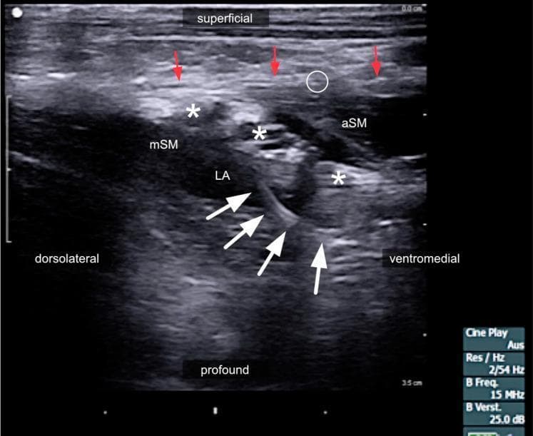This diagnostic ultrasound image demonstrates the left lateral neck region during a continuous interscalene brachial plexus block. The sonogram identifies the anterior scalene muscle (aSM) and middle scalene muscle (mSM) with the interscalene groove located between them. The ventral rami of the brachial plexus are highlighted by white asterisks (*) appearing as hypoechoic oval structures. A white circle indicates the phrenic nerve situated on the anterior surface of the aSM. Red arrows delineate the hyperechoic prevertebral fascia, which acts as a structural boundary for local anesthetic (LA) spread. The LA is visible as a dark, hypoechoic fluid collection surrounding the nerve roots. A medical catheter is identifiable in situ, marked by white arrowheads, positioned deep to the sternocleidomastoid muscle (SCM) and targeting the interscalene space. This image serves as a clinical example of regional anesthesia placement, illustrating the anatomical relationships between cervical musculature, fascia, and neural structures necessary for safe and effective anesthetic delivery.