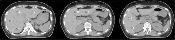 This diagnostic image consists of three axial contrast-enhanced CT scans of the upper abdomen, specifically illustrating hepatic segmental anatomy. The images utilize nine numbered circular markers to identify liver segments based on the Couinaud classification system. The first (superior) slice identifies the caudate lobe (Point 1), the superior left lateral segment (Point 2), the superior left medial segment (Point 4a), and the superior right segments (Points 7 and 8). Subsequent inferior slices identify the inferior left lateral segment (Point 3), inferior left medial segment (Point 4b), and the right lobe segments (Points 5 and 6). Key anatomical landmarks are visible for orientation, including the vertebral body and spinal canal posteriorly, the kidneys, the spleen in the left upper quadrant, and the fluid-filled stomach. The liver parenchyma appears homogeneous, and major vascular structures such as the inferior vena cava and portal venous branches are discernible. This visual serves as a topographical guide for identifying functional liver segments in clinical radiology and surgical planning.