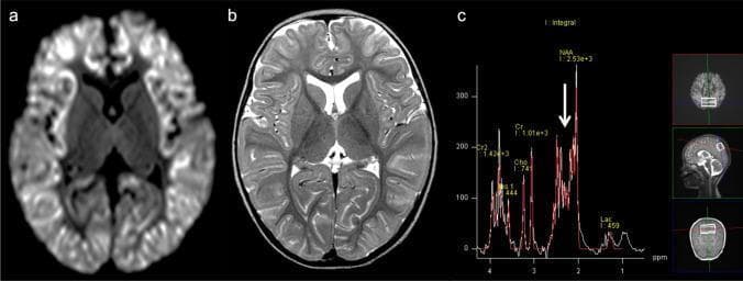 This composite educational image illustrates neuroimaging and spectroscopic findings in a 2-year-old female with Ornithine Transcarbamylase (OTC) deficiency, a urea cycle disorder presenting with acute hyperammonemic encephalopathy. Panel (a) is an axial Diffusion-Weighted Image (DWI) showing a diffuse 'scalloped ribbon' pattern of restricted diffusion throughout the cerebral cortex. Panel (b) is an axial T2-weighted image corroborating these findings with diffuse cortical hyperintensity and edema. The thalami appear relatively spared, a key feature in differentiating urea cycle disorders from hypoxic-ischemic encephalopathy. Panel (c) presents a Proton MR Spectroscopy (1H-MRS) graph (TE = 30 ms) from the bilateral parietal lobes. The spectrum demonstrates a slight elevation in the Glx peak (glutamine-glutamate complex), indicated by a white arrow, alongside standard peaks for NAA, Cr, Cho, and mIns. This diagnostic combination highlights the characteristic imaging signatures of acute metabolic brain injury secondary to neonatal or childhood-onset hyperammonemia.