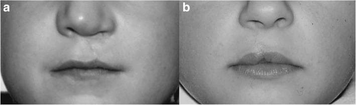 Comparison clinical photographs demonstrating long-term (6-year) postoperative outcomes of two different surgical techniques for unilateral cleft lip repair. Panel A shows the result of a rotation-advancement flap (Millard technique), exhibiting a vertical surgical scar extending from the floor of the nose to the vermilion-cutaneous junction, resulting in mild asymmetry of the philtral columns and Cupid's bow. Panel B illustrates the outcome of a wave-cut method (Pfeifer technique), which utilizes skin elasticity and anatomical muscle reconstruction to restore lip symmetry. Key educational features include the assessment of the nasolabial region, the integrity of the vermilion border, the definition of the philtral dimple, and the vertical height of the upper lip. These images serve as a clinical comparison of reconstructive-surgical procedures in pediatric oromaxillofacial surgery, focusing on aesthetic and functional restoration of the orbicularis oris muscle and surrounding soft tissues.