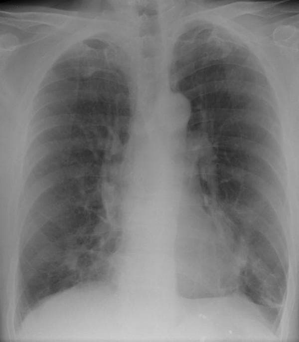 A posterior-anterior (PA) chest X-ray of a human adult. The primary finding is an ill-defined, mass-like opacity located in the right middle lung zone, positioned medially near the right heart border. This density lacks sharp margins and displays a non-uniform, heterogeneous texture. Throughout both lung fields, there is evidence of increased lucency and a subtle reticular pattern, particularly in the upper lobes, which is suggestive of emphysematous changes and hyperinflation. The diaphragms appear slightly flattened, consistent with chronic obstructive pulmonary disease (COPD) or emphysema. There are also scattered, faint, spiculated opacities visible bilaterally in the lung parenchyma. The mediastinal contour and cardiac silhouette are otherwise within normal limits for this view. This image demonstrates findings clinically associated with talc granulomatosis and secondary emphysema, presenting as a mass-like lesion that may mimic malignancy or infectious processes.