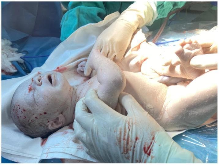 This clinical photograph shows a newborn male infant immediately following delivery, demonstrating severe, generalized pallor of the skin and mucosal surfaces, often described as a 'ghost-like' appearance. The infant is supported by gloved medical personnel in a delivery room setting, surrounded by surgical drapes. Notable features include extremely pale skin across the face, trunk, and extremities, and a marked lack of color in the lips. Superficial dark red-brown spotting and streaks of blood or delivery residue are visible on the scalp, forehead, and chest. The infant's mouth is open, and facial features appear otherwise anatomically normal. Clinically, this extreme pallor is a hallmark sign of severe neonatal anemia or hypovolemic shock, which in this context was caused by massive fetomaternal hemorrhage (FMH). The image serves as a critical educational example of the visual presentation of acute fetal blood loss and the necessity for immediate neonatal resuscitation and volume replacement.