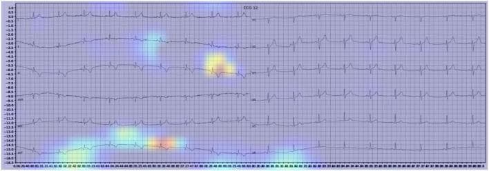 This diagnostic image displays a 12-lead electrocardiogram (ECG) showing signs of myocardial infarction (MI), overlaid with a Gradient-weighted Class Activation Mapping (Grad-CAM) heatmap. The underlying ECG traces are plotted on a standard grid, with vertical fluctuations representing cardiac electrical activity across multiple leads. Superimposed on these traces is a spectral heatmap ranging from blue (low importance) to red (high importance). The heatmap's highest intensity regions (red and yellow focal points) are localized over clinically significant ECG morphology changes, specifically the ST segments and T waves. This visualization illustrates the segments of the waveform that the machine learning model prioritized to identify the pathology. In this clinical scenario, the highlighted areas correspond to ST-segment elevation and T-wave abnormalities characteristic of acute myocardial ischemia or infarction. This comparison is used in medical education to validate artificial intelligence diagnostic reasoning against established human diagnostic criteria for cardiovascular emergencies.