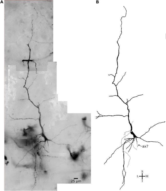This figure presents a comparative study of a single neuron from inner layer VI of the human precuneus. Panel A displays a brightfield photomicrograph of the neuron prepared using Golgi impregnation, highlighting the cellular morphology against the cortical background. Panel B shows a corresponding two-dimensional digital reconstruction produced with specialized software. The neuron exhibits a characteristic spindle- to rod-shaped cell body (soma). It features two prominent, longitudinally oriented primary dendrites: an ascending (superior) dendrite and a thicker descending (inferior) dendrite, both of which show multiple branching points into secondary and collateral segments. A third, thinner primary dendrite is visible, highlighted in gray in the reconstruction. A process identified as a potential axon hillock (indicated by 'ax?') emerges from the soma, though the distal axon is not visualized. The pial surface is oriented at the top of the frame. This material is used to study neuronal diversity, specifically von Economo-like neurons or modified pyramidal neurons, within human cortical cytoarchitecture. Scale bar = 25 μm.