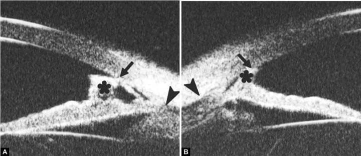 This diagnostic ultrasound biomicroscopy (UBM) image consists of two panels (A and B) illustrating the anterior chamber angle of the eye. The imaging highlights several key anatomical landmarks and pathological findings relevant to glaucoma and angle-closure mechanisms. Schwalbe's line is indicated by black arrows and appears anteriorly displaced and prominent. The scleral spur is identified by black arrowheads as a highly reflective triangular structure posterior to the ciliary body. A distinctive feature in both images is a tissue band (marked by an asterisk) bridging the peripheral iris and the posterior cornea, indicative of peripheral anterior synechiae (PAS). Furthermore, the iris shows a high insertion point into the posterior aspect of the trabecular meshwork, suggesting a narrow angle configuration. These UBM findings are used in ophthalmology to assess the integrity of the drainage angle and determine the pathophysiology of secondary glaucoma when clinical visualization via gonioscopy is obscured.