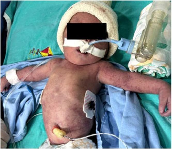 This clinical photograph displays a newborn in a neonatal intensive care setting exhibiting a diffuse petechial rash secondary to congenital chikungunya infection. The skin manifests widespread, small, reddish-purple non-blanching macules and pinpoint lesions across the torso, arms, and legs. The infant is receiving critical care interventions, evidenced by an endotracheal tube secured with white tape for ventilatory support, an umbilical venous or arterial catheter, and ECG monitoring leads on the abdomen. A white knit cap is present on the head, and bandages are visible around both wrists, likely securing intravenous access or monitoring sensors. The image illustrates the dermatological and systemic severity of vertical transmission of CHIKV, highlighting the neonatal presentation of thrombocytopenia and vascular fragility.