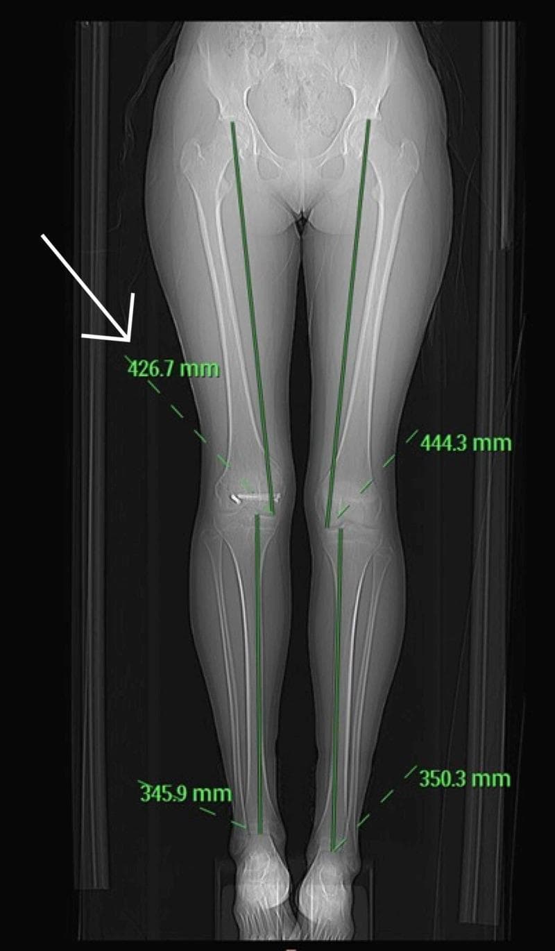 This diagnostic image is a CT scanogram of the lower limbs, a clinical imaging modality used for precise orthometric assessment. The coronal view visualizes the entire lower body skeletal anatomy, including the pelvis, femurs, tibias, fibulas, and feet. Anatomical landmarks for measurement are identified, with digital green measurement lines extending from the femoral heads to the ankle joints. Numerical annotations in millimeters quantify the length of individual long bones: the right femur measures 426.7 mm compared to the left femur at 444.3 mm, and the right tibia measures 345.9 mm compared to the left tibia at 350.3 mm. Visible surgical hardware (orthopedic screws) is noted in the distal right femur, consistent with a history of fracture fixation. The primary educational focus is the quantification of limb length discrepancy (LLD) following pediatric trauma and physeal injury. The image demonstrates how scanography provides an objective basis for surgical planning, such as epiphysiodesis, by comparing corresponding segments on the contralateral side.