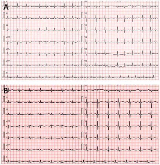The image consists of two 12-lead electrocardiogram (ECG) tracings, labeled A and B, displayed on a standard grid. Panel A shows a pre-procedure ECG demonstrating atrial fibrillation, characterized by an irregularly irregular rhythm with varying R-R intervals and the absence of discernible P waves. The QRS complexes are narrow, and the baseline shows minor wandering artifact but no significant interference. Panel B shows a postoperative 12-lead ECG. This tracing displays a regular rhythm with a heart rate of approximately 120 beats per minute, consistent with sinus tachycardia. Each QRS complex is narrow and preceded by a discernible P wave in most leads, indicating a return to sinus rhythm following intervention (radiofrequency catheter ablation). The T waves in both tracings appear normal in morphology across the limb (I, II, III, aVR, aVL, aVF) and precordial (V1-V6) leads, with no obvious signs of acute ST-segment elevation or depression. This comparison serves as clinical documentation of rhythm conversion from atrial fibrillation to sinus tachycardia in a patient post-ablation.