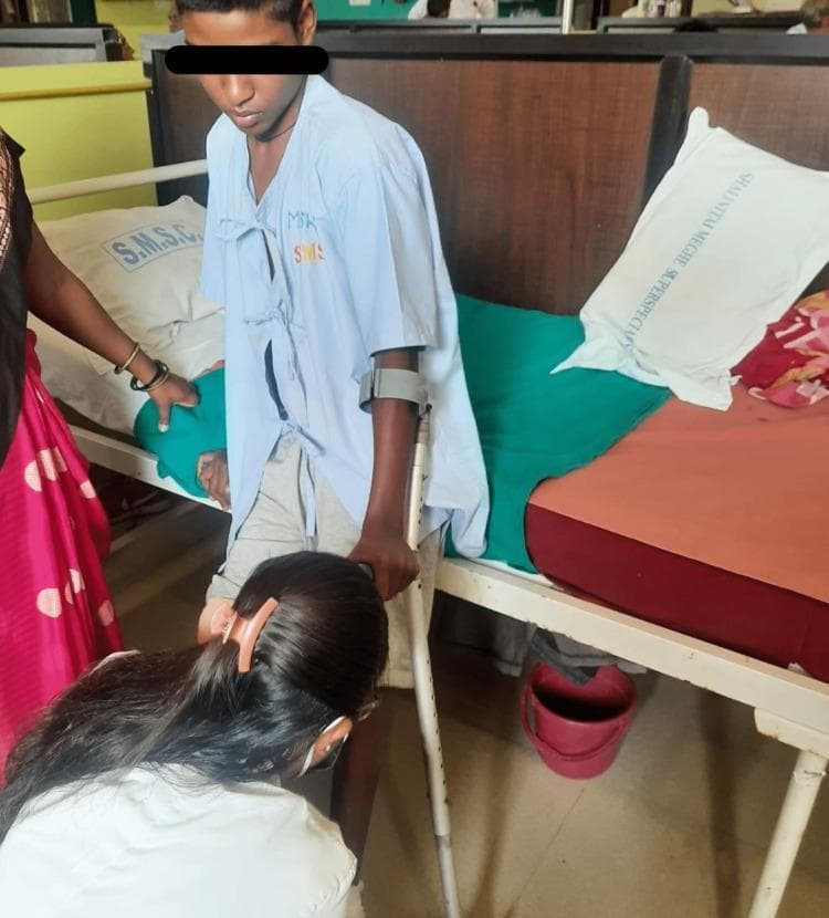Clinical photograph depicting a pediatric or adolescent patient undergoing postoperative gait training in a hospital setting. The patient is shown standing next to a hospital bed, wearing a light blue medical gown and gray shorts. To facilitate ambulation, the patient is utilizing a forearm crutch (Lofstrand crutch) on the left side. A physical therapist is positioned at the patient's feet, manually assisting with foot placement and supporting the lower extremity during the gait cycle. The clinical context involves rehabilitation following a right below-knee amputation and a left-foot wedge tarsectomy for congenital talipes equinovarus (CTEV). The image demonstrates the multidisciplinary approach to post-surgical recovery, focusing on independent mobility, weight-bearing stabilization, and the use of assistive devices. The hospital environment includes labeled pillows and standard medical furniture, emphasizing the transition from acute surgical care to active physical therapy and prosthetic preparation.