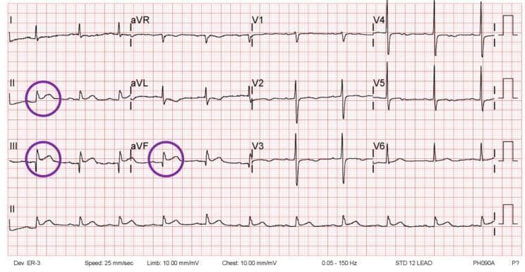 This diagnostic image is a standard 12-lead electrocardiogram (ECG) tracing on a red grid background, illustrating an acute inferior wall ST-elevation myocardial infarction (STEMI). The tracing displays the six limb leads (I, II, III, aVR, aVL, aVF) and the six precordial leads (V1-V6), with a continuous rhythm strip of lead II at the bottom. Purple circles highlight significant ST-segment elevation at the J-point in the inferior leads: II, III, and aVF. The ST elevation is approximately 1 mm or greater with a convex or upward-sloping morphology. Reciprocal ST-segment depression is visible in the high lateral leads (I and aVL), which is a classic finding in inferior STEMI. The precordial leads (V1-V6) show a normal R-wave progression without acute ST-segment changes. This ECG is a key educational tool for cardiovascular medicine, specifically for diagnosing acute coronary syndromes and identifying regional wall ischemia or infarction patterns.