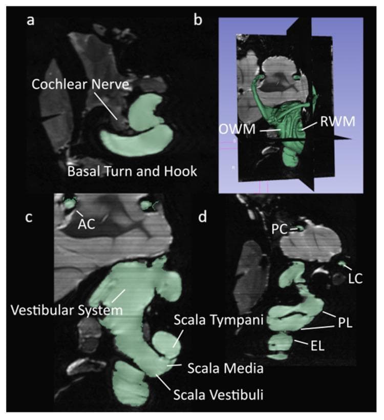 This diagnostic imaging composite displays high-resolution segmented micro-MRI (µMRI) scans of the inner ear anatomy. The images use a green overlay to highlight the lymphatic fluid spaces within the membranous labyrinth. Panel (a) shows a transverse plane depicting the cochlear nerve and the basal turn and hook of the cochlea. Panel (b) provides a 3D volumetric reconstruction, illustrating the spatial relationship between the oval window membrane (OWM) and the round window membrane (RWM). Panel (c) is a sagittal section highlighting the vestibular system and the anterior canal (AC). Panel (d) presents a coronal plane view that clearly differentiates the cochlear duct compartments: the scala tympani, scala media, and scala vestibuli. Additional vestibular structures such as the posterior canal (PC), lateral canal (LC), perilymph (PL), and endolymph (EL) are labeled. This set of images serves as a detailed anatomical reference for the complex fluid-filled chambers and neural structures of the auditory and vestibular systems, relevant for otolaryngology and audiology education.