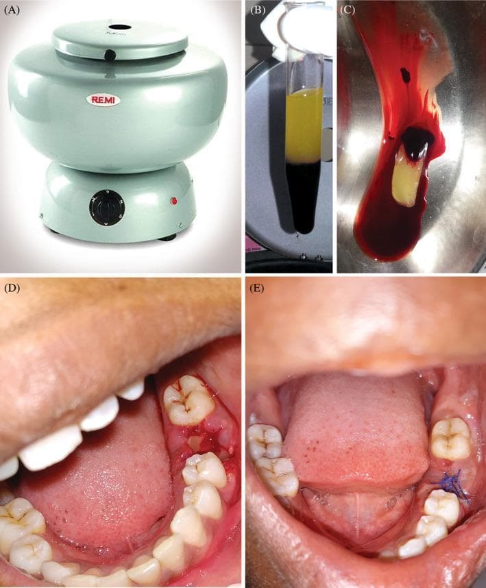 A multi-panel series illustrating the preparation and clinical application of Platelet-Rich Fibrin (PRF) in oral surgery. (A) Shows a clinical centrifuge used for blood processing. (B) Demonstrates a post-centrifugation glass test tube showing the separation of blood into three layers: a bottom layer of red blood cells, a middle 'buffy coat' PRF clot, and an upper layer of acellular plasma. (C) Displays the harvested PRF clot, appearing as a dense, yellowish-white fibrous gel. (D) An intraoral clinical photograph showing the PRF clot being placed into a fresh mandibular molar extraction socket to promote hemostasis and bone regeneration. (E) An intraoral follow-up photograph at the 7th postoperative day, showing the surgical site with blue monofilament sutures in place. The wound demonstrates primary intention healing with healthy pink gingival margins and reduced inflammation compared to the immediate postoperative state. This sequence illustrates the autologous regenerative process used to enhance soft and hard tissue healing in dental procedures.