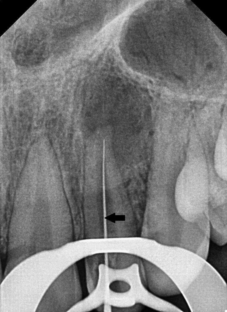 This diagnostic intraoral periapical (IOPA) radiograph demonstrates a working length determination procedure for the left maxillary lateral incisor. A radiopaque endodontic file is positioned within the root canal of the tooth, which exhibits an immature, open apex indicative of incomplete root formation or apical resorption. A significant periapical radiolucency is visible surrounding the apex, suggesting chronic periapical pathology or abscess. The periodontal ligament (PDL) space appears widened along the root surface. Anatomically, the radiolucent shadow of the nasal cavity and the floor of the nasal fossa are visible superior to the root apices. A highly radiopaque rubber dam clamp is placed over the cervical region of the tooth for isolation during the endodontic treatment. This image serves as an educational example of managing non-vital immature teeth requiring apexification and illustrates the radiographic method of calculating canal length in a pediatric endodontic context.