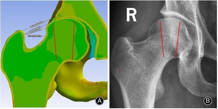 A side-by-side comparison illustrating finite element (FE) modeling and clinical imaging of the proximal femur. (A) A biomechanical model of a right hip joint showing von Mises stress transmission pathways. The proximal femur and acetabulum are color-coded (green and yellow) to represent mechanical stress distribution. Spring models connect the greater trochanter to the ilium, simulating the support provided by the hip ligaments (iliofemoral, pubofemoral, and ischiofemoral). Two vertical red lines indicate the orientation of principal stress pathways within the femoral head. (B) A matching anteroposterior (AP) X-ray of a human right proximal femur. The radiographic image shows the dense cortical bone and the intricate trabecular patterns (compressive and tensile trabeculae) within the femoral neck and head. Superimposed red lines correspond to the orientation of the primary pressure osteons and trabecular groups, validating the computational model's representation of bone architecture and stress-bearing regions. This comparison is used to study disease mechanisms like femoral head necrosis and the mechanical impact of surgical interventions.