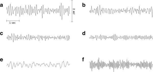 This diagnostic image displays a series of six representative 5-second electrocardiogram (ECG) waveform segments (labeled a-f) illustrating the progression of ventricular fibrillation (VF) over time. The segments correspond to 1, 4, 6, 8, 10, and 12 minutes post-VF induction. Initially (1 min), the waveform shows high-amplitude, coarse VF with disorganized but rapid electrical activity. From 4 to 10 minutes, there is a visible trend toward 'fine' ventricular fibrillation, characterized by a progressive decrease in both amplitude and dominant frequency as the myocardium becomes increasingly ischemic and depleted of ATP. At 10 minutes (panel e), the rhythm is near-isoelectric with very low amplitude. However, at 12 minutes (panel f), following the initiation of oxygenated blood perfusion, there is a stark morphological shift back to high-amplitude, high-frequency coarse VF. This sequence demonstrates the clinical significance of myocardial oxygenation and metabolic state in influencing VF morphology and the potential for successful defibrillation (often correlated with AMSA—Amplitude Mid-frequency Spectrum Analysis).