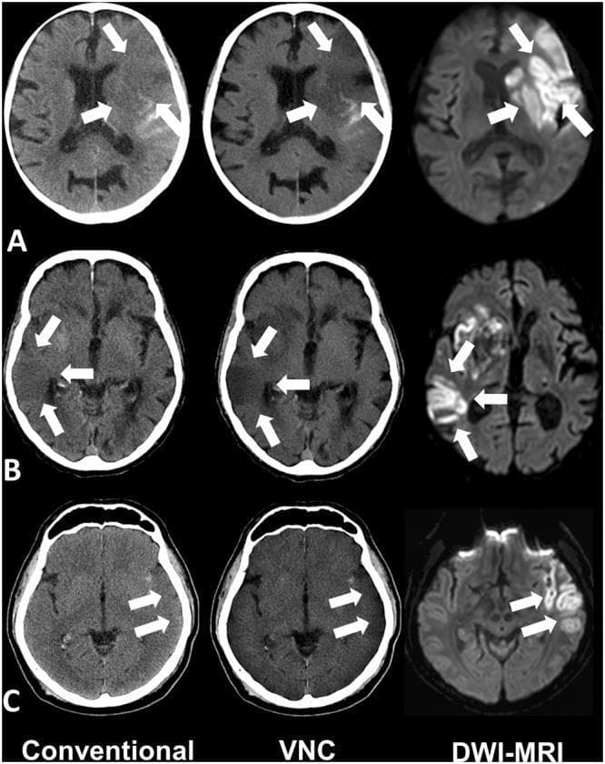 This diagnostic imaging panel displays axial brain scans from three different patients (A, B, and C) comparing three modalities: Conventional Non-Contrast CT, Virtual Non-Contrast (VNC) spectral CT, and Diffusion-Weighted Imaging (DWI-MRI). The images illustrate acute ischemic stroke following mechanical thrombectomy. White arrows indicate regions of acute infarction. In the 'Conventional' CT column, the ischemic lesions appear as subtle, poorly defined areas of hypodensity (low attenuation) within the brain parenchyma. In the 'VNC' CT column, these same lesions demonstrate more pronounced hypodensity and increased contrast-to-noise ratio, making the infarct boundaries clearer compared to conventional CT by removing potential iodine contrast masking. The 'DWI-MRI' column serves as the gold standard, showing corresponding regions of high signal intensity (hyperintensity), which represents restricted water diffusion characteristic of acute cytotoxic edema. The cases highlight infarctions in various territories, including the left and right middle cerebral artery (MCA) regions. This comparison demonstrates the clinical utility of spectral CT VNC reconstructions in improving the detection of early ischemic changes that may be subtle on standard CT.