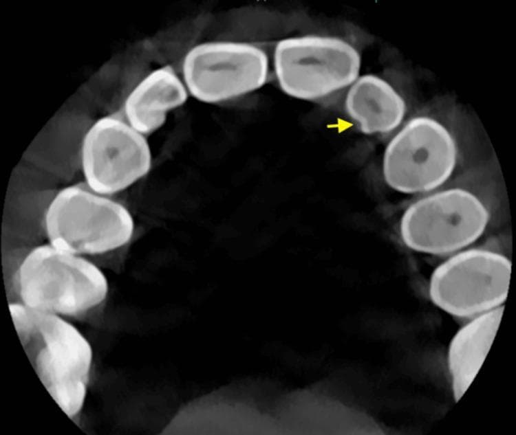 Diagnostic Image: This axial section of a Cone Beam Computed Tomography (CBCT) scan displays the maxillary dental arch. The imaging shows a clear view of the dental anatomy, highlighting the contrast between the highly radiopaque outer enamel, the less dense dentin, and the central radiolucent pulp chambers. A yellow arrow points to the palatal aspect of the left maxillary lateral incisor, identifying a distinct invagination known as a palatogingival groove (PGG). This developmental anomaly appears as a radiolucent indentation or depression in the enamel and dentin layers. The surrounding teeth, including the central incisors and the right lateral incisor, serve as a comparison, exhibiting smooth and continuous palatal contours. This visualization is critical for endodontic and periodontal assessment, as such grooves can act as conduits for plaque accumulation and may lead to localized periodontal destruction or combined endo-perio lesions. The image is an essential educational resource for dental students and specialists in periodontics and endodontics focusing on tooth morphology and its clinical implications.