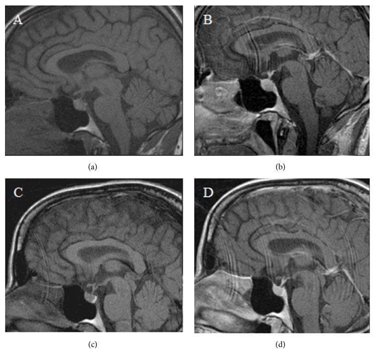 This set of four sagittal brain MRI images illustrates diagnostic findings in the pituitary region across two timepoints: immediate postpartum (a, b) and four months postpartum (c, d). Images (a) and (c) are pre-contrast T1-weighted sequences, while (b) and (d) are post-contrast sequences. The primary anatomical focus is the sella turcica containing the pituitary gland, positioned inferior to the optic chiasm and hypothalamus. In the initial postpartum scans (a, b), there is a notable absence of the normal hyperintense 'bright spot' in the posterior pituitary on T1-weighted imaging, a finding clinically associated with arginine vasopressin (AVP) depletion and transient diabetes insipidus. In contrast, the follow-up images at four months (c, d) demonstrate the reappearance of this physiological T1 hyperintensity in the posterior pituitary, signifying AVP repletion and recovery. Other midline structures, including the corpus callosum, brainstem, and cerebellum, appear morphologically normal across all frames. These images serve as an educational example of neurohypophyseal signal changes related to transient gestational or postpartum diabetes insipidus.