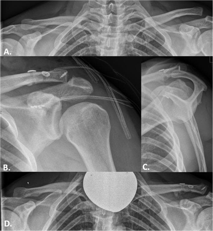 A series of conventional radiographs detailing the management of a Rockwood type IIIb acromioclavicular (AC) joint injury in a 42-year-old patient. Panel A is a preoperative bilateral panoramic view showing a significant superior displacement of the distal clavicle relative to the acromion on the left side, with an increased coracoclavicular (CC) distance. Panels B and C represent immediate postoperative anterior-posterior and Alexander views, respectively, demonstrating surgical reduction and fixation using coracoclavicular suspensory implants (buttons and high-strength sutures). The alignment of the acromion and distal clavicle is restored, and surgical hardware is visible superior to the clavicle and inferior to the coracoid process. Panel D is a 67-month follow-up panoramic radiograph showing stable maintenance of the AC joint reduction. Key features include subtle heterotopic ossification in the coracoclavicular ligament region and intact implants without evidence of migration or secondary dislocation. The comparison illustrates successful surgical stabilization and long-term osseous remodeling in orthopaedic trauma management.