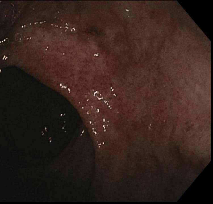 This diagnostic image is a clinical photograph obtained during a colonoscopy, showing the mucosal lining of the rectum. The visual field demonstrates key features of active ulcerative colitis, characterized by moderate endoscopic activity (Mayo Score 2). The rectal mucosa exhibits significant diffuse erythema and a granular, irregular texture, indicating active inflammation. Key pathological findings include a loss of the normal vascular pattern and the presence of numerous small, punctate lesions and friability across the mucosal surface, consistent with superficial ulcerations and erosions. The educational focus of this image is the recognition of endoscopic signs of inflammatory bowel disease (IBD), specifically the transition from healthy tissue to inflamed, erythematous, and damaged mucosa in a patient with left-sided ulcerative colitis. This clinical imaging is essential for medical students and gastroenterology trainees to understand the visual markers used in the classification and monitoring of disease severity in ulcerative colitis.