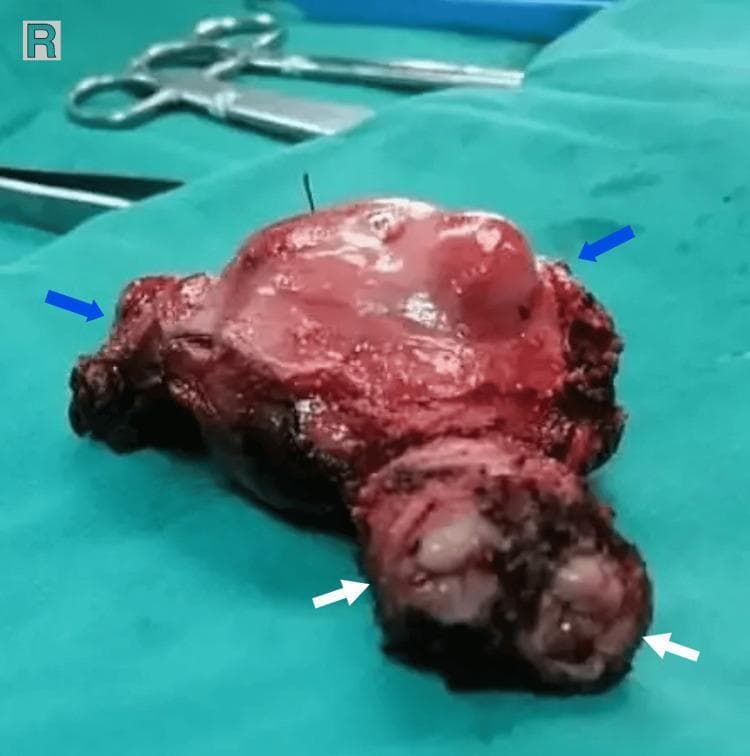 This clinical photograph shows a gross pathological specimen of a total abdominal hysterectomy featuring a congenital Mullerian duct anomaly, specifically a didelphys uterus. The specimen, measuring approximately 9 x 5 x 4 cm, is displayed on a green surgical drape. Blue arrows indicate two distinct uterine horns: the left horn (40 mm) and the right horn (35 mm). The upper portion of the specimen shows a smooth, reddish-pink serosal surface with visible hemorrhagic areas. White arrows at the inferior aspect of the specimen point to two separate cervixes, which share a common cervical canal. This anatomical variation is characteristic of uterine didelphys, a class III Mullerian anomaly resulting from the failure of the paramesonephric ducts to fuse during embryogenesis. The image provides significant educational value for gynecology and pathology, illustrating both the gross external morphology of a double uterus and the associated cervical duplication, which are key diagnostic features in reproductive tract malformations.