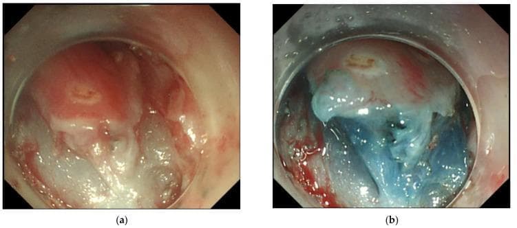 This endoscopic clinical photograph depicts the stages of endoscopic submucosal dissection (ESD) performed on an esophageal lesion following prior radiofrequency ablation (RFA). Image (a) shows the post-RFA mucosal environment, characterized by pink tissue with interspersed white, irregular patches indicating mild submucosal fibrosis and thermal effect. Image (b) demonstrates the procedural step of submucosal elevation. A glycerol solution mixed with indigo carmine dye (blue) has been injected, successfully expanding the submucosal space and creating a distinct blue-tinged cushion. This elevation facilitates the dissection of the target tissue from deeper muscular layers. The content illustrates management strategies for residual or recurrent superficial esophageal squamous cell neoplasia (SESCN), highlighting how ESD can overcome RFA-induced fibrosis through deep submucosal plane dissection. The visual is intended for intermediate to advanced gastroenterology training, focusing on therapeutic endoscopy techniques and tissue response to thermal ablation.