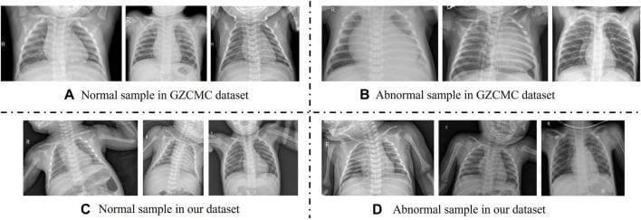 This diagnostic image provides a comparison chart of pediatric chest X-ray (CXR) samples from two different sources: the Guangzhou Women and Children’s Medical Center (GZCMC) dataset and a clinical dataset for retrospective study. The visual is divided into four quadrants (A-D) showcasing the variability in pediatric imaging.
Quadrants A and C display 'Normal' samples. Normal CXRs show clear lung fields, visible ribcage structures, and a defined mediastinum. Quadrants B and D display 'Abnormal' samples (consistent with pneumonia), characterized by increased opacity, consolidation, and infiltrates within the lung fields.
A key educational focus of the comparison is the difference in image acquisition. The GZCMC samples (A, B) demonstrate standard, centered positioning focused on the thoracic cavity with minimal artifacts. In contrast, the clinical dataset samples (C, D) demonstrate real-world variability in pediatric radiography, including rotated postures, varying shooting areas, and the presence of arms across the chest, which adds irrelevant information to the diagnostic field. This serves to illustrate the challenges of developing automated diagnostic models that must account for non-standardized patient positioning in clinical practice.