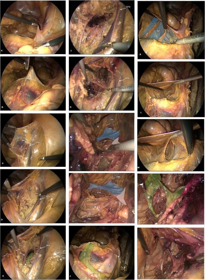 This composite of 15 laparoscopic photograms (labeled a-o) illustrates a step-by-step dissection of the retroperitoneal pelvic anatomy. The series follows a surgical progression starting from the sacral promontory and right psoas muscle (a-c), moving into the obturator fossa to identify the genitofemoral nerve (GFN), obturator nerve (ON), and lumbosacral trunk (LST) (d-f). Deeper dissection in panels g-i highlights the sciatic notch and floor of the pelvis, identifying the ischial spine, sacrospinous ligament (asterisk), iliococcygeus muscle (ICM), and pudendal neurovascular bundle. Panels j-m focus on the presacral space and superior hypogastric plexus (SHP), while n-o demonstrate the sacral nerve roots (S2-S4) and the inferior hypogastric plexus (IHP) with associated pelvic splanchnic nerves (PSN). High-contrast overlays—including blue for endopelvic fascia and green for neural plexuses—and white anatomical labels help distinguish complex neural, vascular, and muscular structures. This educational resource is designed to teach laparoscopic surgical landmarks and spatial relationships within the female pelvic retroperitoneum.