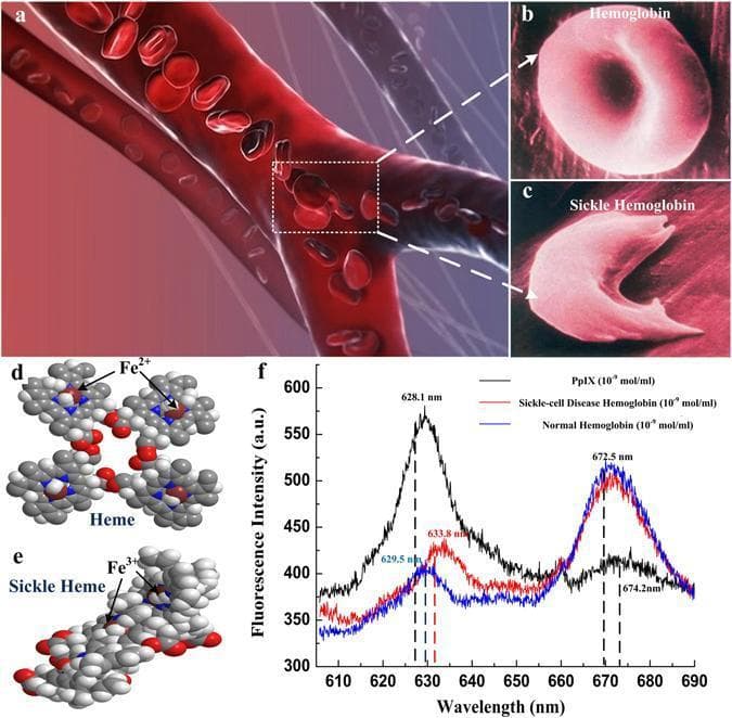 A multi-panel medical illustration and data graphic comparing normal hemoglobin and sickle cell disease (SCD) hemoglobin. (a) A 3D schematic of a bifurcating blood vessel showing the movement of red blood cells. (b, c) Magnified views contrasting the flexible, biconcave disc morphology of normal hemoglobin with the rigid, elongated, crescent or sickle shape characteristic of SCD hemoglobin, illustrating the mechanism for vascular occlusion. (d, e) Ball-and-stick molecular models detailing Heme (with Fe2+) and Sickle Heme (associated with Fe3+), emphasizing structural differences at the molecular level. (f) A comparative fluorescence spectrum plot showing Protoporphyrin (black), Sickle-cell Disease Hemoglobin (red), and Normal Hemoglobin (blue) across wavelengths of 610–690 nm. The graph highlights diagnostic spectral shifts: Protoporphyrin peaks at ~628.1 nm, while hemoglobin variants show distinctive primary peaks at ~672.5 nm and secondary peaks showing shifts (629.5 nm for normal vs. 633.8 nm for sickle). This composite image serves to correlate clinical hematology, cellular morphology, and molecular spectroscopy in the study of Sickle Cell Anemia.